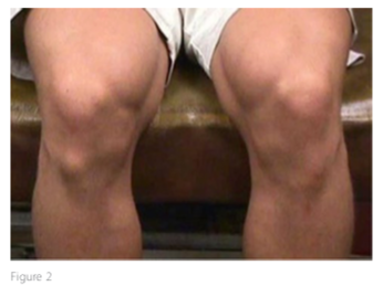 Reduction in Osgood-Schlatter's Syndrome symptomology due to Jumpsoles training regimen